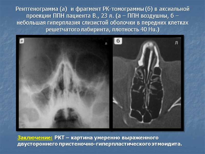 Рентгенограмма (а)  и фрагмент РК-томограммы (б) в аксиальной проекции ППН пациента В., 23